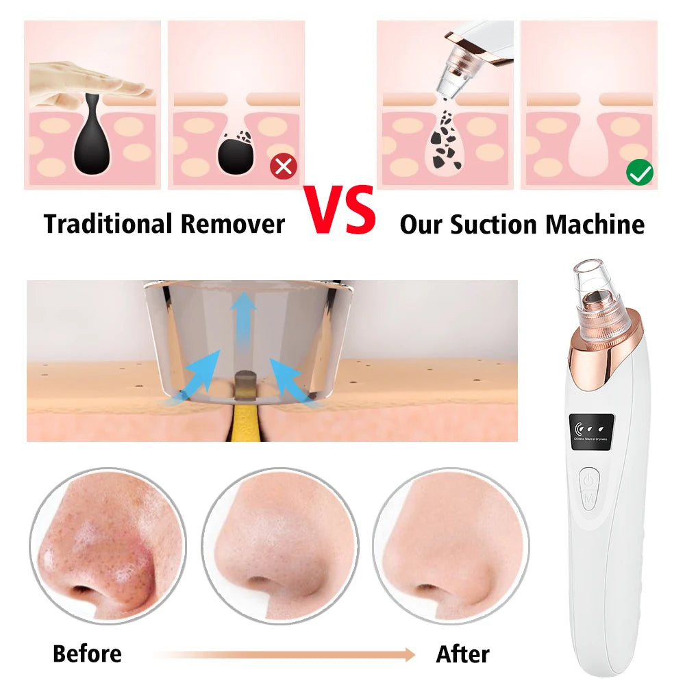 Electric Blackhead Remover Vacuum Suction Pore Cleaner Acne Pimple Black Head Dots Extractor Facial Cleaning Skin Care Korean